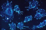 Εξελίξεις στην έρευνα για τον καρκίνο του παγκρέατος