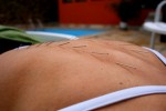 Βελονισμός: αποτελεσματικός όσο «μια εικονική θεραπεία»