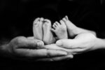Σιαμαία ενωμένα στο κεφάλι διαχωρίστηκαν στο Ισραήλ